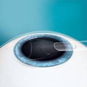 ICL lente intraoculare.jpg