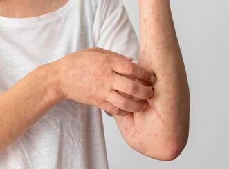 alergia-brazo