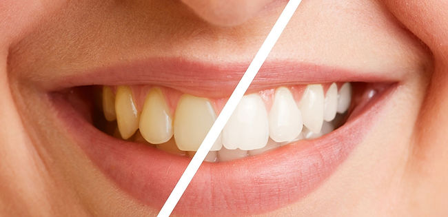 Clareamento Dental.jpg