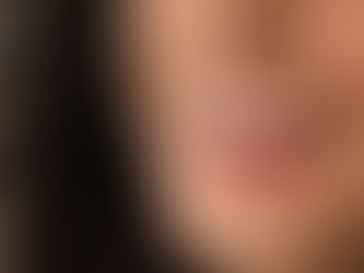 Facetas de resina: agilidade e harmonia para o seu sorriso