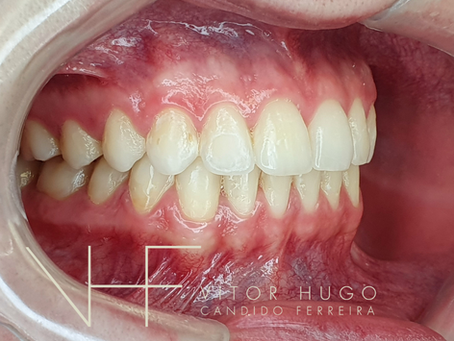 Cirurgia Ortognática em Curitiba: O guia completo.