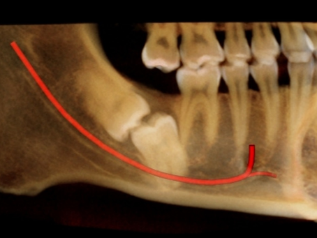 LASERTERAPIA PARA PARESTESIA