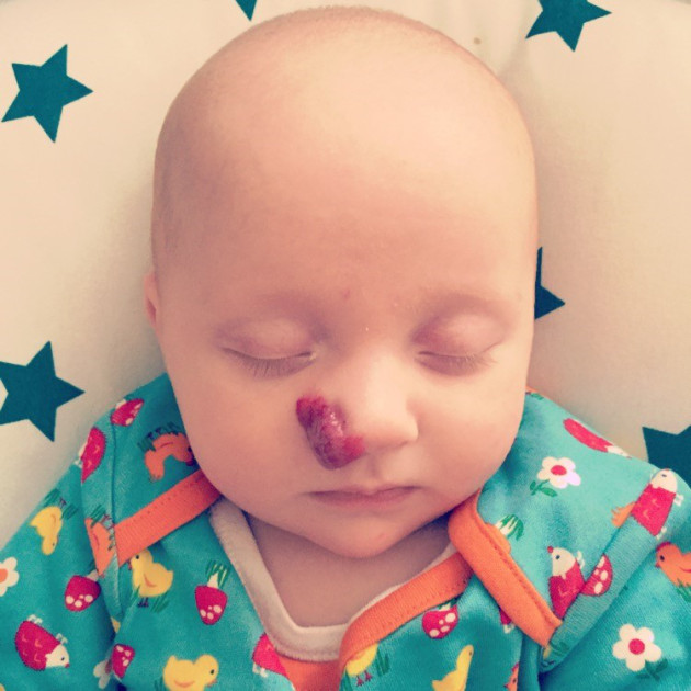 Baby Haemangioma As Cute As A Strawberry
