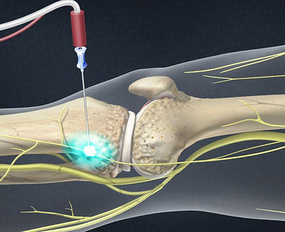 knee rf.jpg