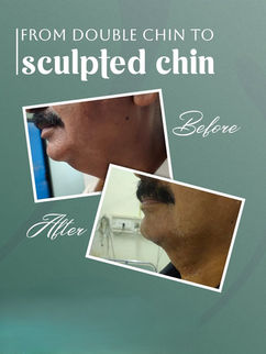 Chin Treatment in Vizag