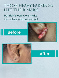 Ear Surgery in Vizag
