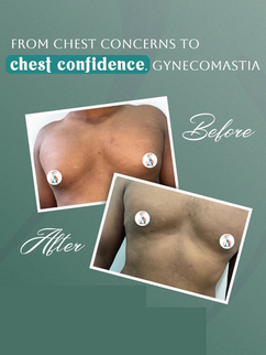 Gynecomastia Treatment in Vizag
