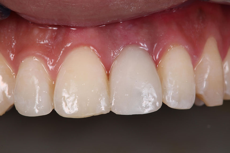 Temporary tooth to shape the gum