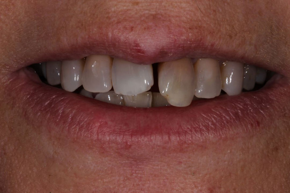 Are Immediate Dental Implants Better?