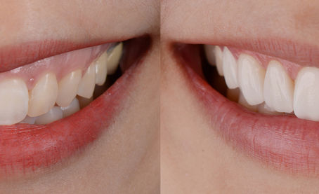 What is Smile Design with Porcelain Veneers?