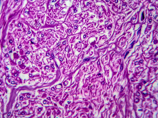 Acupuncture For Fibroids, What Are Fibroids, & Fibroid Symptoms Wellington