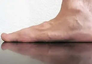 FlatFeet.webp