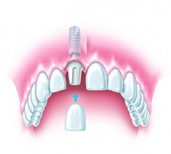 nadomestitev zoba z implantatom - implantat, abutment, prevleka