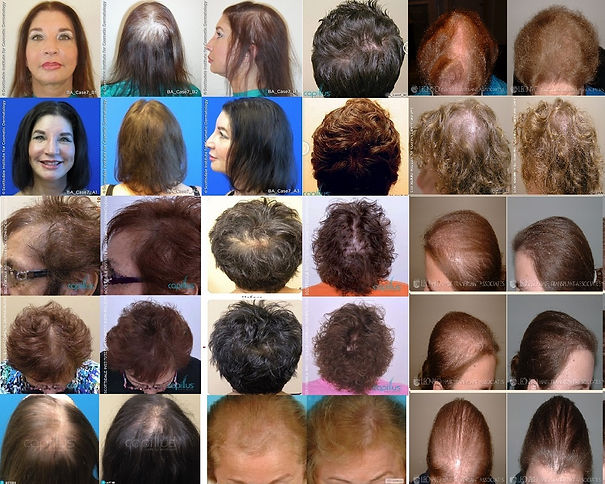 低出力レーザ―　Capillus（カピラス） 女性の使用例