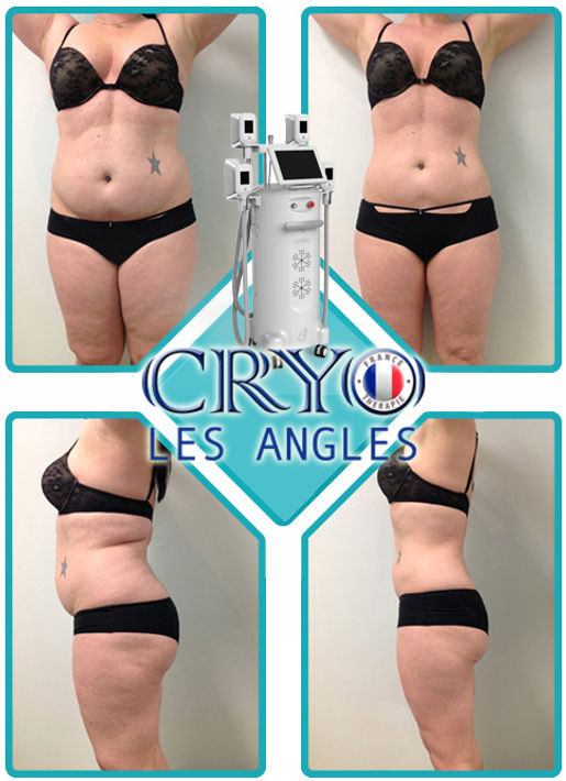 Cryolipolyse, avant et après