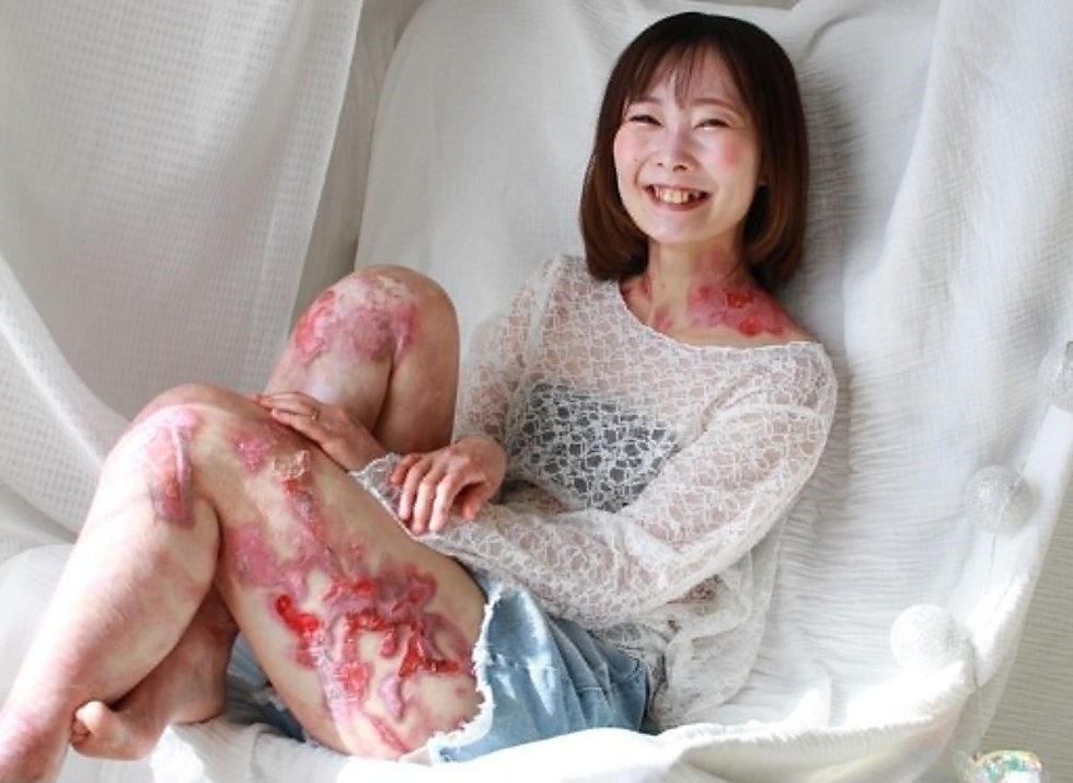Photo Exhibition in Abashiri raises awareness of Epidermolysis Bullosa in Japan