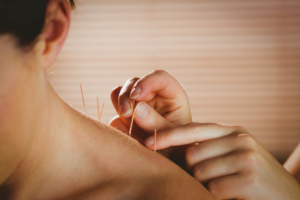 needling treatment or acupuncture