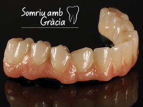 ¿Una prótesis que no se mueve y parece un diente real? Sí, es el circonio sobre implantes
