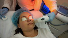 My Experience with Microneedling and IPL Photofacial