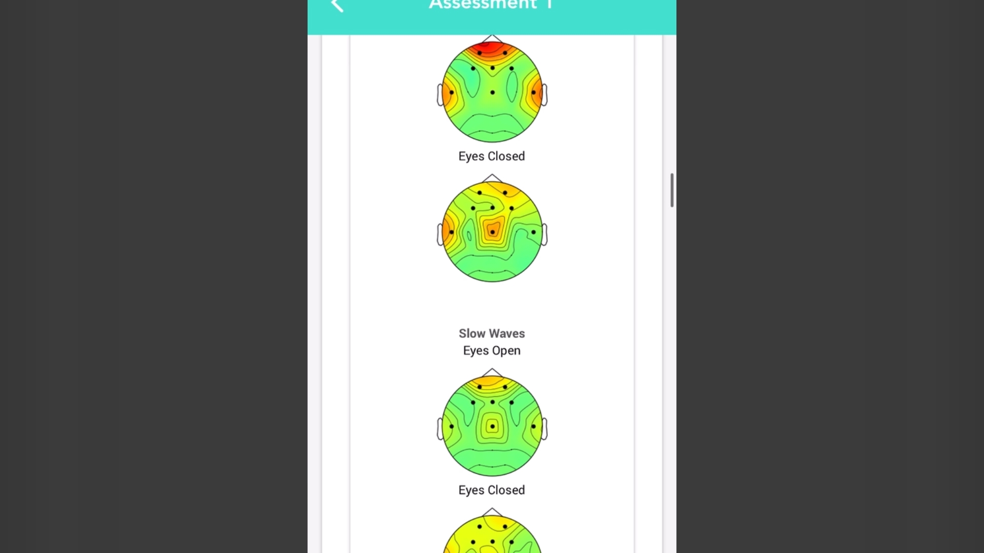 Myndlift Brain Maps