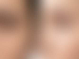 Un'immagine "Before & After" (o simulata) focalizzata su una zona specifica come il contorno occhi o la naso-labiale, mostrando la differenza tra una pelle segnata e una pelle "piena" e luminosa.