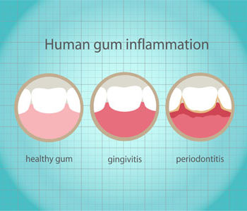 gum treatment in delhi