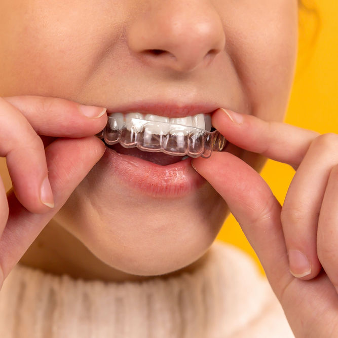 Invisalign Treatment in Delhi 