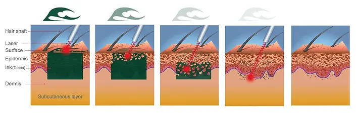 Tattoo-removal-4.webp