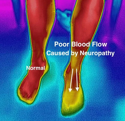 infrared picture of poor blood flow in legs