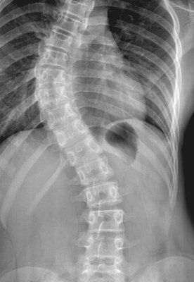 scoliosis-xray-female