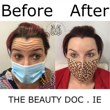 A short guide to Botulinum Toxin