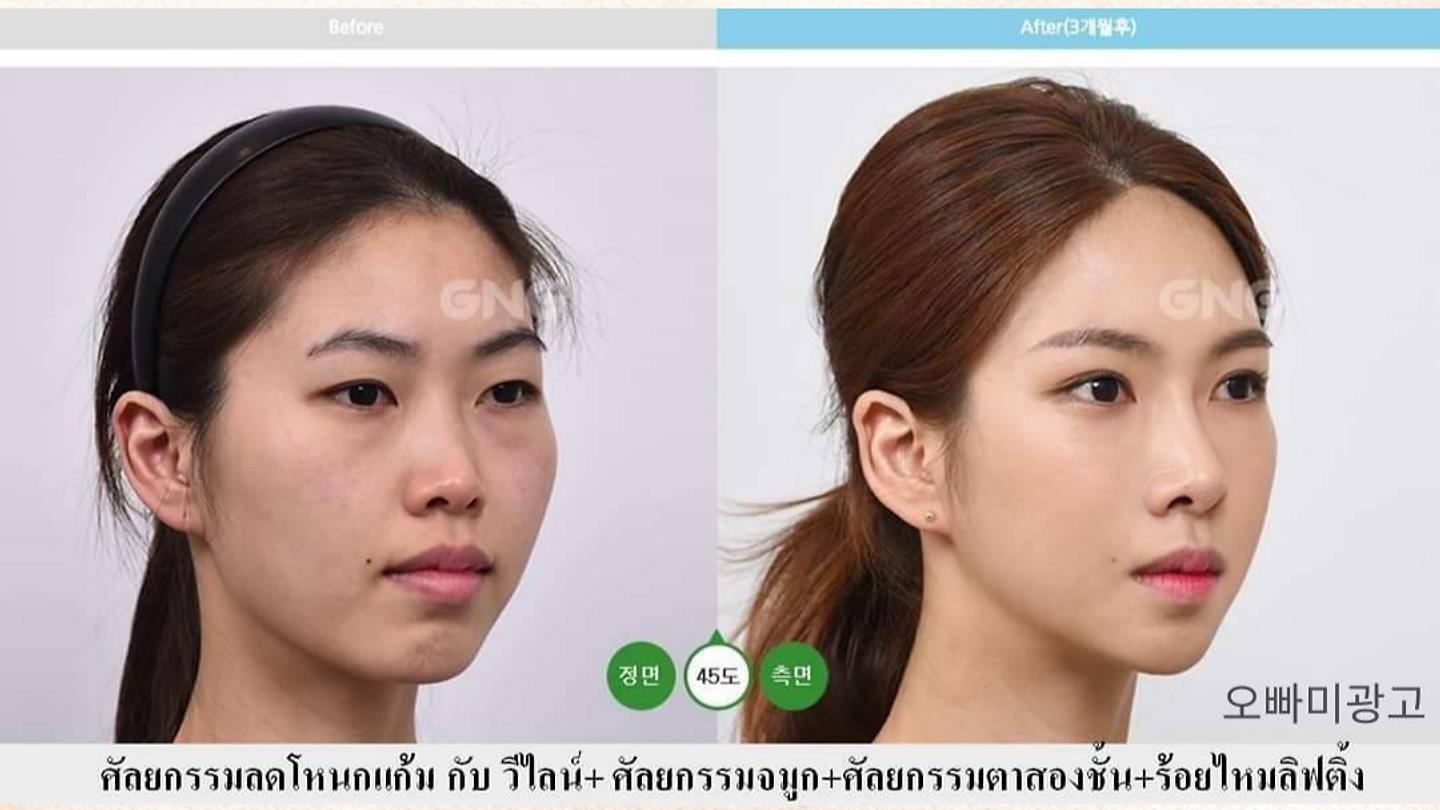 รีวิว ศัลยกรรมลดโหนกแก้ม วีไลน์