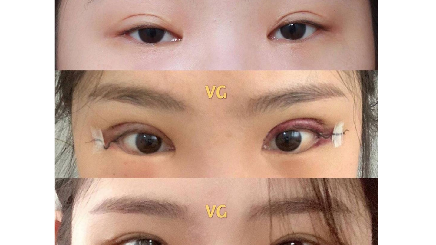 รีวิวการปรับแก้ไขตา (ตอนที่ 2)