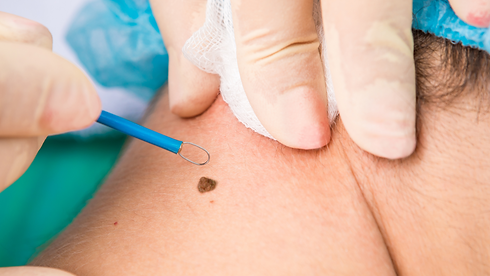 surgical dermatology, mole, etc, Dr. Zikhona Gxolo.png
