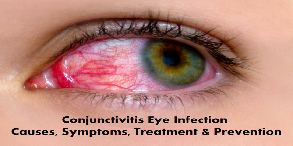 conjunctivitis-eye-infection-causes-symptoms-treatment-prevention