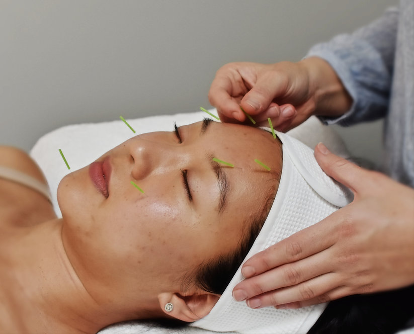 Cosmetic Acupuncture
