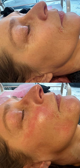voor na impressie behandeling Clinical Microneedling by Mesoskinline
