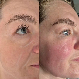 voor na impressie behandeling Clinical Microneedling by Mesoskinline
