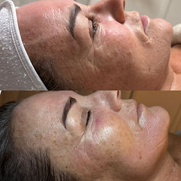 voor na impressie behandeling Clinical Microneedling by Mesoskinline