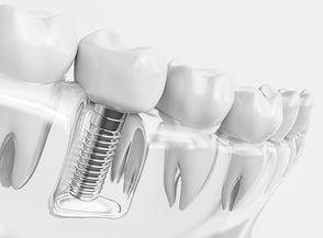 Dental-Implant-Feat-1-scaled.jpeg