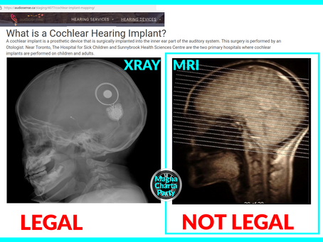 COCHLEAR SKULL IMPLANTS by SADISTIC AUSTRALIA