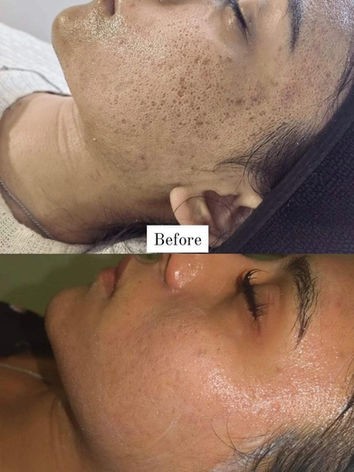 Acne scaring