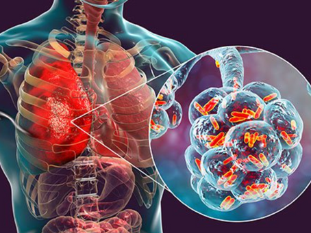 La neumonÃa bacteriana causó la mayorÃa de las muertes en la pandemia de influenza de 1918