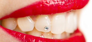 Strass_dentaire_bijou_dent.jpeg
