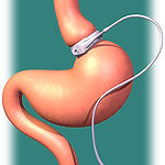 Lapband1.jpg