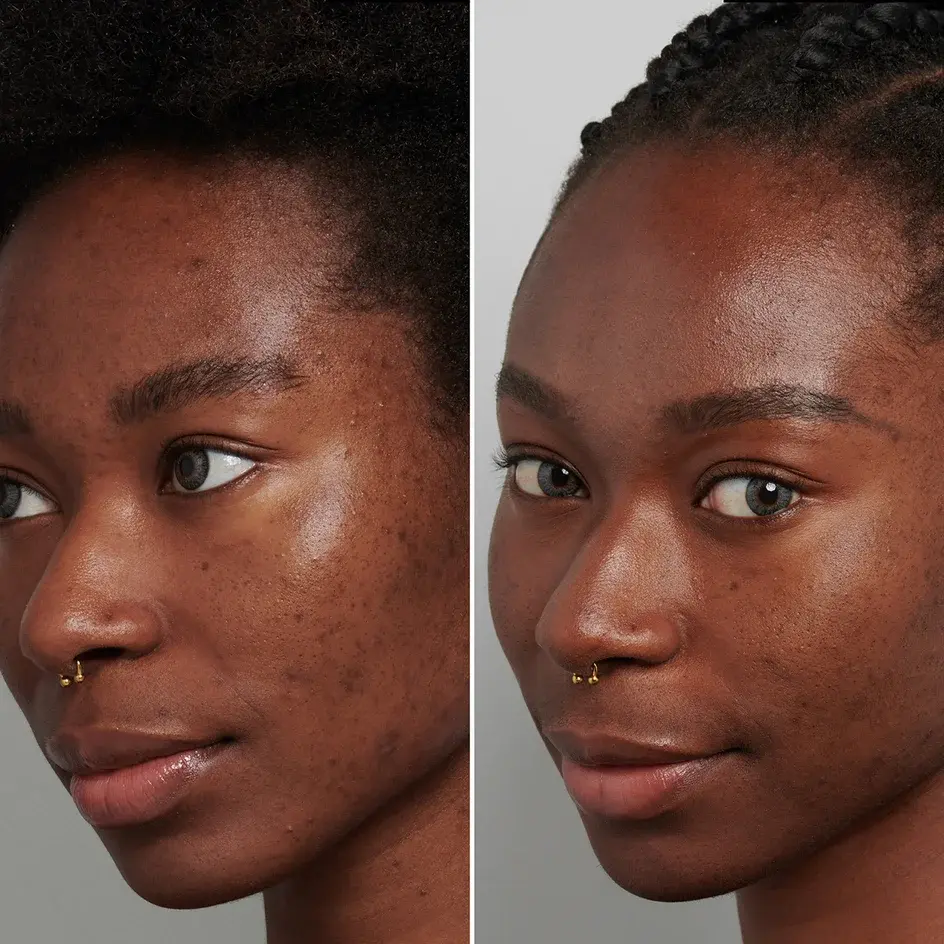 Miniature : Avant et après : peau plus lisse