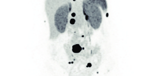 Anterior-maximum-intensity-projection-images-of-68-Ga-DOTATATE-A-and-18-F-FDG-B.png