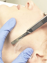 Dermaplaning