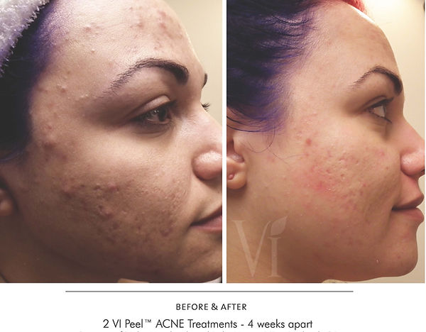 Copy of acne patient.dr.hayes_edited.jpg
