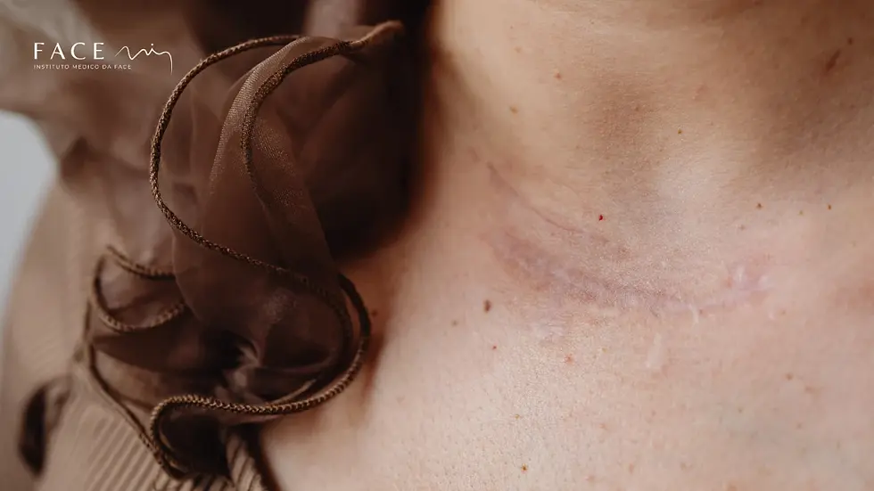 Tipo de Cicatriz: Hipertrófica, Atrófica ou Quelóide? O guia essencial para entender o seu tipo de cicatriz e a escolha certa do tratamento